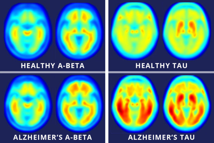 tau imaging in Alzheimer's disease